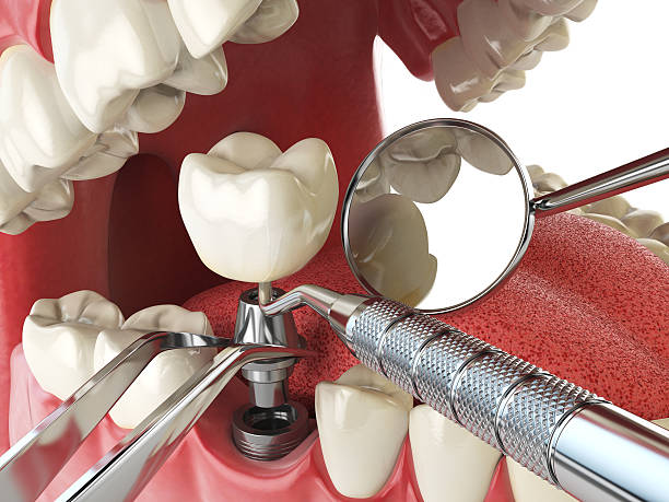 Best Chipped Tooth Repair Near Me  in Aberdeen, MD